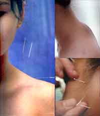 Autism Acupuncture, Autism Neuro Acupuncture, Autism Herbal Herbs, Autism Medicine, Autism Acupuncture Treatment Cure, Neuro Autism Acupuncture Centre